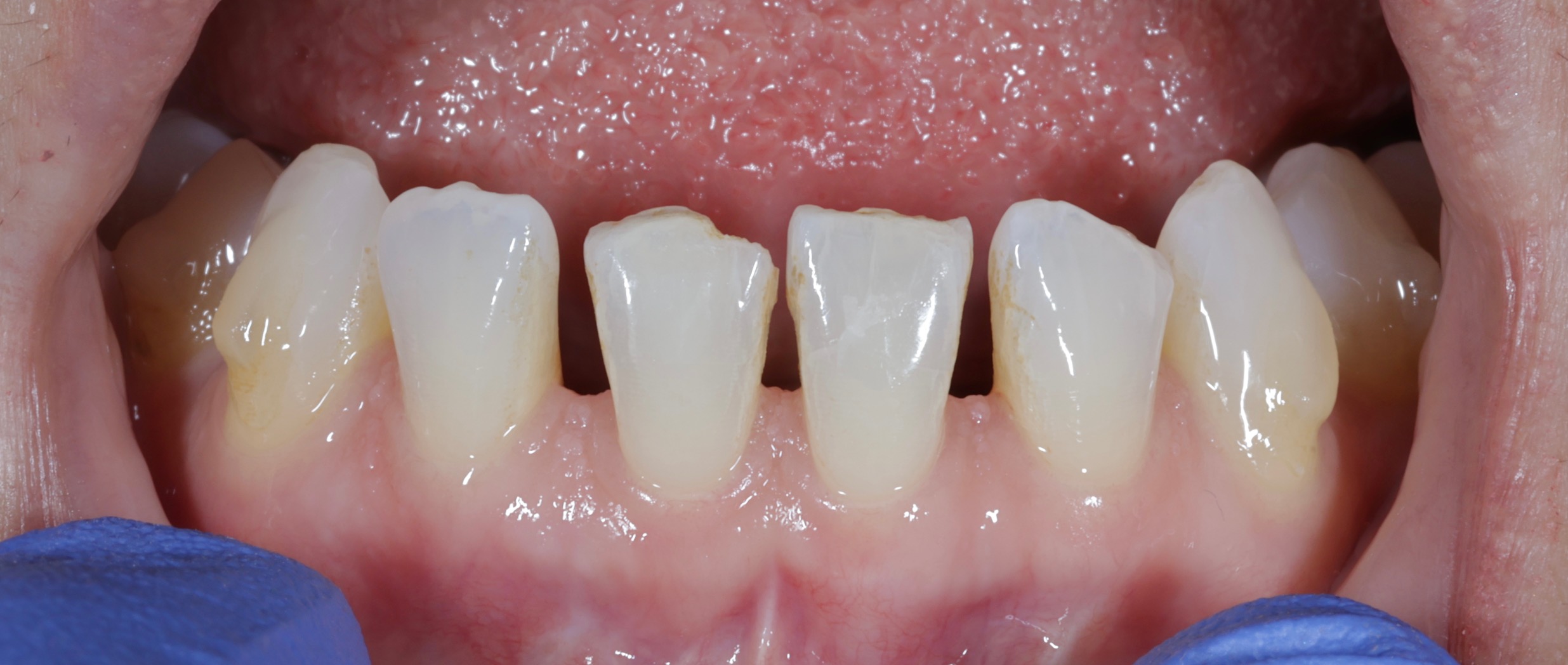 Restorative Space Closure